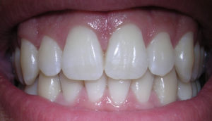 Professional whitening for your teeth
